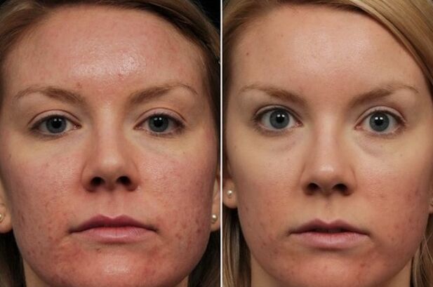 Rejuvenescimento a laser