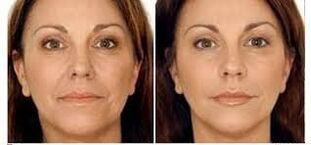 antes e depois