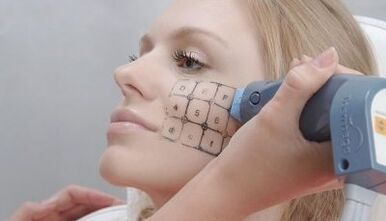 Como é realizado o rejuvenescimento fracionado
