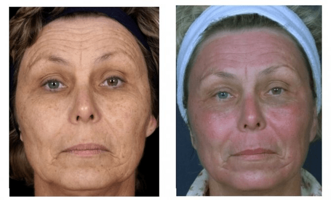 período de reabilitação após rejuvenescimento