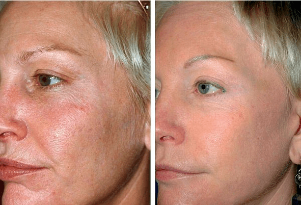 resultar em foto antes e depois