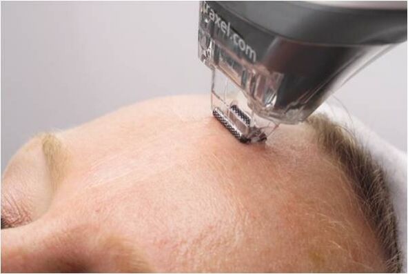 procedimento de peeling para rejuvenescimento da pele facial